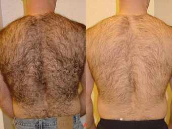 depilacion-laser-masculina-antes-despues[1]